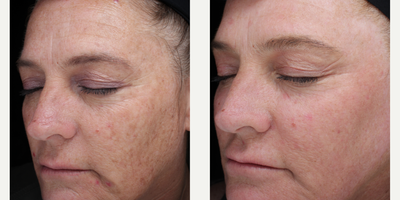Woman treated with Renuvion - Woman treated with Renuvion