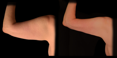 35-45 year old woman treated with Body Jet - Hi definition water assisted (BodyJet) and ultrasound assisted (VASER) contouring of the legs including the inner and outer thighs for lipedema, a genetic condition of disproportionate fat cells with associated pain and swelling.