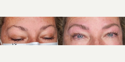 Woman treated with Microblading - Woman treated with Microblading