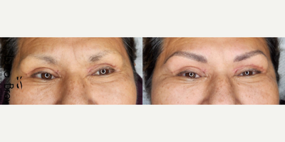 Woman treated with Microblading - Woman treated with Microblading