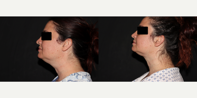 35-44 year old woman treated with FaceTite, Laser Liposuction - Cosmetic Liposuction patient who had tumescent liposuction to the chin and neck with Renuvion Skin Tightening.