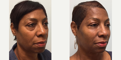 ALMI facial rejuventation - ALMI (Autologous Lipocyte Micronized Injection) was used for facial rejuvenation on this 63 year old patient. With ALMI, her own tissues were used to restore lost volume around her nasolabial folds and to fill in the hollows below her eyes.