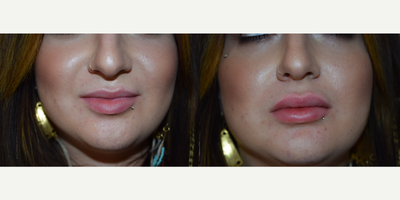 25-34 year old woman treated with Lip Augmentation - This young woman desired fuller lips. She had 1cc of Juvederm Ultra Plus XC injected into her upper and lower lip. The result shown is immediately following the injection.