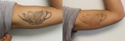 PicoSure Laser Tattoo Removal after Four treatments - Patient wanted to remove a large tattoo on upper left Bicep. Here are results after four treatments with the PicoSure Laser for Tattoo Removal.