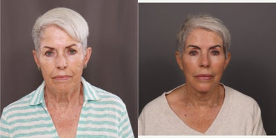 75 and up year old woman treated with Facelift, Double Eyelid Surgery, Facial Fat Transfer, Laser Resurfacing, Botox, Dermal Fil - Facelift, Upper & Lower Blepharoplasty, Fat Grafting by Dr. Thompson. Contour TRL, Botox, Dermal Fillers, and Hydrafacial. 3 years post-operative.
