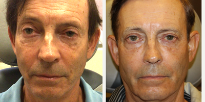 65-74 year old man treated with Canthoplasty - This previous patient came to Dr. Ghafouri wanting to discuss rejuvenation of his face that he feels is deflated and sagging. Dr. Ghafouri performed fat grafting, bilateral lower lid canthoplasty and our laser technician performed fractionated C02 for texture and tone of his skin.