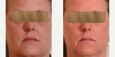 Halo Laser - Photo provided courtesy of Sciton, Inc, performed by Rebecca Gelber, MD