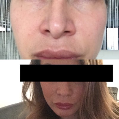 Rhinoplasty Booked Comfort Zone Surgery Istanbul Dr Ilker