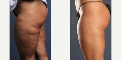 35-44 year old woman treated with Cellulaze - Cellulaze