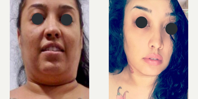 Chin Liposuction  - Little touch / big change by Mallol.Jaw angle improvement bringing youth to her facial contour after chin intense liposuction.