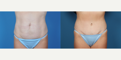 25-34 year old woman treated with Tummy Tuck - Tummy Tuck