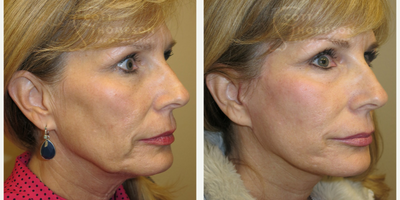 45-54 year old woman treated with MACS Facelift - 54 year-old female with MACS Facelift performed by Dr. Scott Thompson