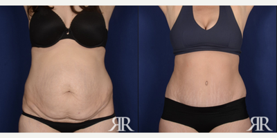 35-44 year old woman treated with Diastasis Recti Repair - Diastasis Recti Repair