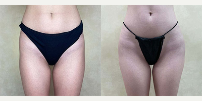 Woman treated with Hip Augmentation - Woman treated with Hip Augmentation