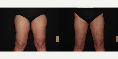 55-64 year old woman treated with Lipedema Surgery, Laser Liposuction - Lipedema Reduction Surgery to her inner and anterior thighs, lateral thighs and buttocks.