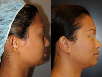 30 year old woman treated with Ear Surgery (aka Otoplasty) - This female patient aged 30 was treated with an ear surgery (aka otoplasty.) The after photo was taken 2 years and 10 months post-surgery.