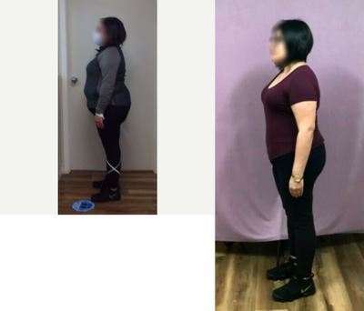 25-34 year old woman treated with Endoscopic Sleeve Gastroplasty - She lost 51 LBS in 13 months after her Endoscopic Sleeve Gastroplasty.