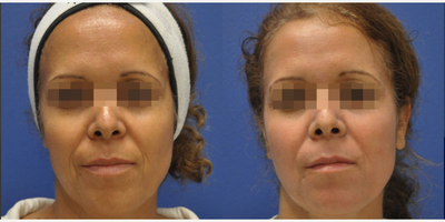 Woman treated with SmartSkin CO2 laser - Woman treated with SmartSkin CO2 laser