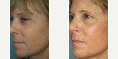 54 year old woman treated with InMode Fractora around the mouth and eyes - High energy InMode Fractora around the mouth and eyes only.