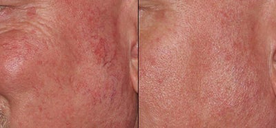 Excel 532 laser treatment  broken capillaries on left cheek before and after photo - status post 3 weeks after Excel 532 laser to treat broken capillaries