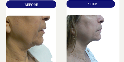 45-54 year old woman treated with Fractora RF, Forma, Facial, Skin Tightening, Skin Rejuvenation - FRACTORA FIRM-FORMAbipolar radiofrequency