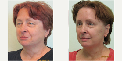 55-64 year old woman treated with Lower Facelift, Neck Lift, Upper Eyelid Surgery - This working woman in her late 50s presented with the concern of looking tired and angry all of the time. She stated that she did not like the heaviness over her eyes and that her lower face and neck were quite saggy.Examination revealed significantly hooded eyes that even effected her peripheral vision, as well as significant laxity of her lower facial tissue and neck. We decided on performing an lower facelift with necklift and an upper blepharoplasty.Both procedures were performed under local anesthesia with the addition of oral sedation with alprazolam (xanax). Total procedure time was 2 1/2 hours. The majority of the stitches were removed on post-op day 6 and she returned to work on day 10.Her results demonstrate significant opening of both eyes as well as considerable decrease in the overall heaviness of her lower face and neck.