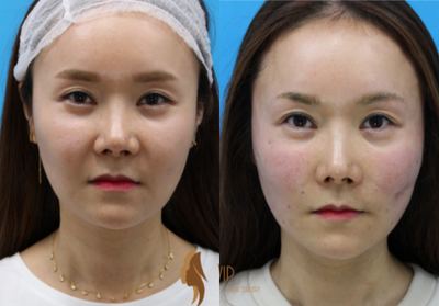 35-44 year old woman treated with Thread Lift - One day post op after threadlift