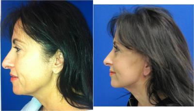 Mini facelift - 
	Interest in mini facelift and lower eyelid lift.
