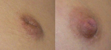 Correction of the inverted nipple - 	Correction of an inverted nipple. This patient also had a breast augmentation which is why her areola looks a little more stretched in the after picture
