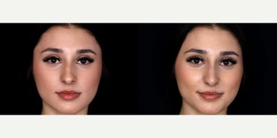 24 year old woman treated with Vollure, Nonsurgical Nose Job - 24 year old woman treated with 0.7 syringe of Vollure, Nonsurgical Nose Job. Photos depict before and immediately after treatment.