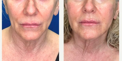 55-64 year old woman treated with Laser Liposuction, Nonsurgical Facelift, Nonsurgical Neck Lift, Skin Tightening, Skin Rejuvena - Endolift Laser is a revolutionary treatment for tightening, contouring unwanted jowl and neck fat along with stimulating your skin collagen. The procedure is relatively painless. You walk in the office and walk out with very few limitation, no scars and an improved appearance with continues to get better over the next 6 months. This Endolift Laser is used in Europe and is now offered in Connecticut.