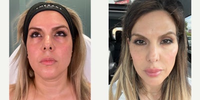 JAW DROPPING FEMALE FACIAL SCULPTING - JAW DROPPING FEMALE FACIAL SCULPTINGOur patient has always longed for a structured, symmetrical, supermodel face. She had previous neck lipo and renuvion with us - and now it's time to strategically use fillers to create stunning contour and definition. This is true artistry and she trusts no one but us for this task. We focus on her cheeks, jawline, and chin to create symmetry and breathtaking beauty while taking some anti-aging measures in injecting filler to her folds and the corners of her mouth to prevent drooping. The last step was to delicately address her lips, which is an easy area to overdo and requires the most experienced hands. We successfully gave her an increase in volume while maintaining a natural aesthetic. FEMALE FACIAL SCULPTING Cheek Chin Jawline Folds Lips