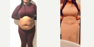 25-34 year old woman treated with Tummy Tuck, Liposuction, Brazilian Butt Lift - Excellent outcome after full tummy tuck combined with intense liposuction including abdomen, waist, laterals and upper and lower back to improve your body contour and get better curves, especially in your waist area and dominican butt lift.