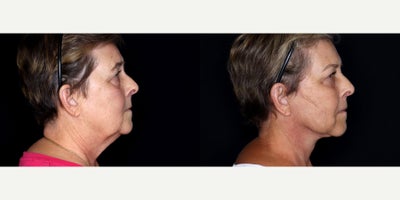 65 year old woman treated with Facelift, Neck Lift, Eyelid Surgery, Cheek Lift, Facial Fat Transfer - 65 year old woman treated with Facelift, Neck Lift, Eyelid Surgery, Cheek Lift, Facial Fat Transfer. Photos depict before and 3 months after surgery.
