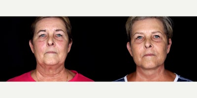 65 year old woman treated with Cheek Lift - 65 year old woman treated with Facelift, Neck Lift, Eyelid Surgery, Cheek Lift, Facial Fat Transfer. Photos depict before and 3 months after surgery.