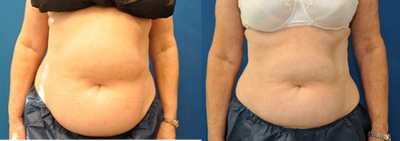 CoolSculpting - CoolSculpting