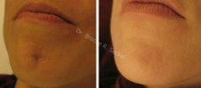 Starlux 1540 for Scar removal and skin plumping - 
	Before and after scar removal and skin scar plumping with Starlux 1540 non-ablative laser.
