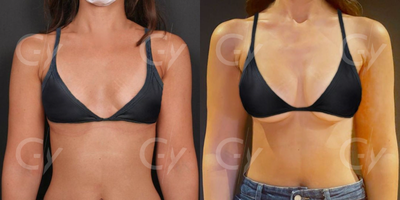 25-34 year old woman treated with Breast Augmentation - 25-34 year old woman treated with Breast Implants, Breast Augmentation by M.D. Gray Yeiladal