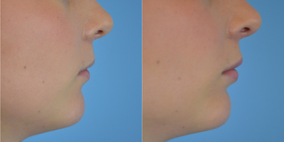 18-24 year old woman treated with Restylane Silk to lips - 23 year old female received a lip augmentation with 1 syringe of Restylane Silk to the upper and lower lips; photos depict the patient's results 1 month post-op.