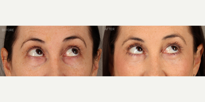 Upper and Lower Blepharoplasty with Fat Grafting and CO2 Laser - 38-year-old female with a history of displeasure with her upper eyelid contour and excess skin, and lower eyelid aging. She had tried and failed undereye fillers many times before deciding to undergo surgery. She is shown 6 months after an upper blepharoplasty (eyelid lift) with fat transposition to reduce upper eyelid skin redundancy and create a more youthful contour. She also underwent a transconjunctival (scarless) lower blepharoplasty to remove lower eyelid bags, fat grafting to the eyelids and mid-cheek to contour areas of hollowness, and fractionated CO2 laser to tighten and smooth skin.
