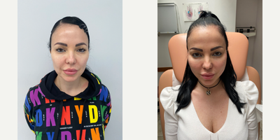 25-34 year old woman treated with Contour Thread Lift - Nonsurgical facelift with PDO threads, immediate long lasting results, safe procedure performed under local anesthesia, with minimal or no downtime