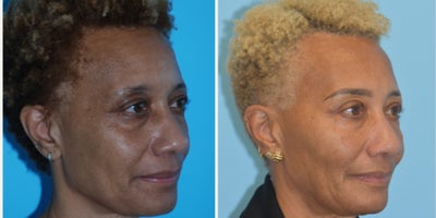 55-64 year old woman treated with Eyelid Surgery, Neo Laser, Dermal Fillers, Botox, Morpheus8 - This patient is shown 6 years after her initial photo.  She underwent neurotoxin, filler to the midface, morpheus skin tightening, aerolase neo treatments, microneedling, hydrafacials and regular skin care use.  Additionally, she is shown 1 month after upper blepharoplasty.  Looking the like herself but has aged backwards.