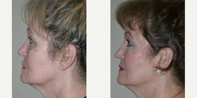63 year old woman treated with Silhouette InstaLift - 63 year old woman treated with Silhouette InstaLift to cheeks, shown 1 year post op. She also had PDO Threads around the corners of her mouth as well as Facial Fat Transfer to her temporal areas, cheeks, infra orbital/tear troughs, and to her upper eyelid hollows. Post op, she had fuller cheeks, softer cheek curves, softer lower lid-cheek junction, and better defined angle of her jaw.