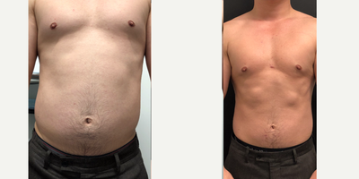 35-44 year old man treated with VShape Ultra Laser Treatment - After 3 treatments of lower abdomen and bilateral flank