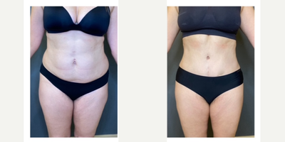 35-44 year old woman treated with Tummy Tuck, Liposuction, Liposculpture, Diastasis Recti Repair, Mommy Makeover - 44 year old mom who is shown before and 20 months after full tummy tuck with rectus diastasis muscle repair and liposuction of the flanks and lateral thighs. Her pants and dress size decreased  by 2-3 sizes!Ht. - 56. Wt- 174lbs  before and 160lbs after!