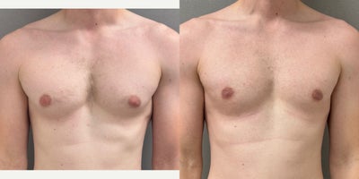 33 yo s/p gynecomastia liposuction and excision performed under local anesthesia with sedation in our on site AAAA certified ope - 33 yo s/p gynecomastia liposuction and excision performed under local anesthesia with sedation in our on site AAAA certified operating suite.