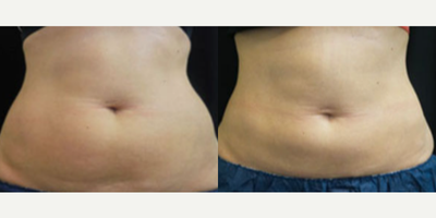 Woman treated with CoolSculpting - Woman treated with CoolSculpting
