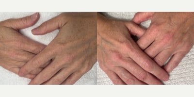 55-64 year old woman treated with Hand Rejuvenation - BBL (Broad Band Light) on hands.