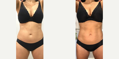 Vanquish - Woman treated with Vanquish