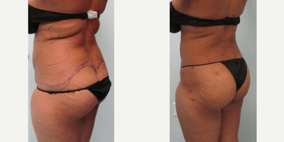 Gruber Booty - Lipo Only! No Injections, No Implants, No Fat Grafts - AWAKE liposuction, tiny pinpoint scars, minimal 3 day downtime, easy recovery. Dr. Gruber sculpts your body in a natural way to create a rounder, lifted appearance to the buttocks with the least amount risk possible.